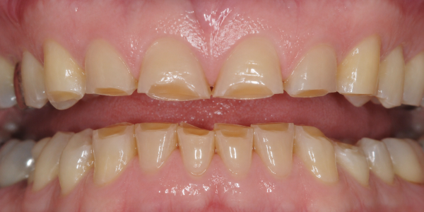 USURE DES DENTS